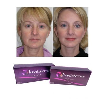 6-9 месяцев Длительность использования Juvederm Dermal Filler Gel для покупки онлайн и в магазине