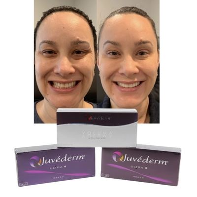 Juvederm Dermal Lip Fillers Гиалуроновая кислота с перекрестной инъекцией