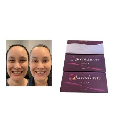 Скрещенный HA Juvederm Dermal Filler Ultra3 Ultra4 Volume Условия хранения Избегайте замораживания Инъекционный гель для восстановления объема лица